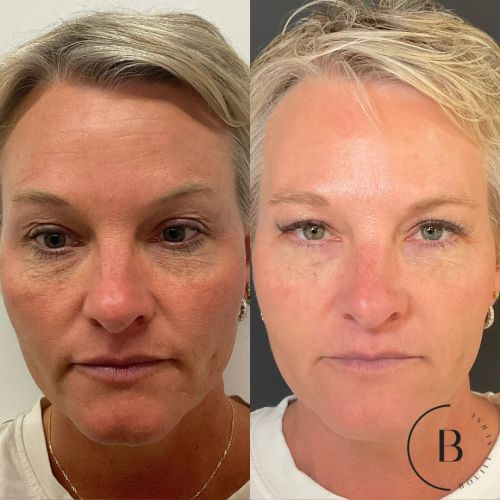 Collagen Restoration before and after results at Boujee Nurse