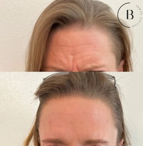 Wrinkle Relaxation before and after results at Boujee Nurse