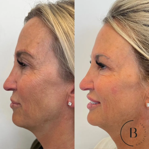 Full Facial Balancing before and after results at Boujee Nurse