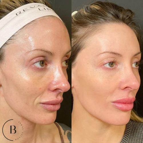 Laser Skin Renewal before and after results at Boujee Nurse