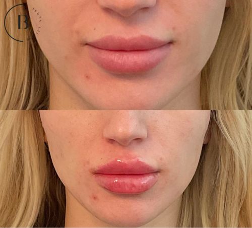 Lip Enhancement before and after results at Boujee Nurse