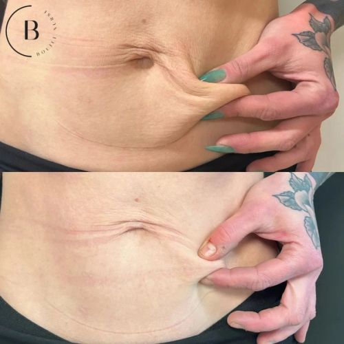 Abdominal Skin Tightening before and after results at Boujee Nurse