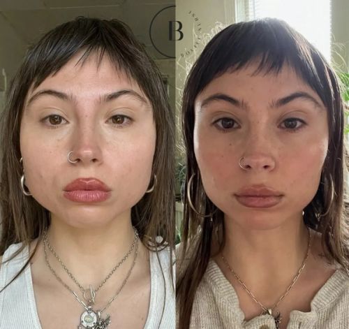 Jawline Slimming before and after results at Boujee Nurse
