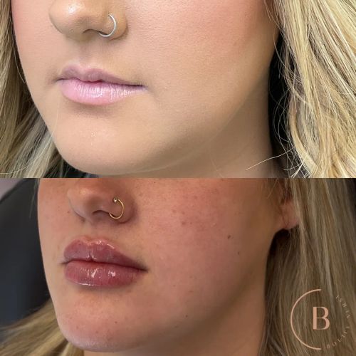Lip Enhancement before and after results at Boujee Nurse