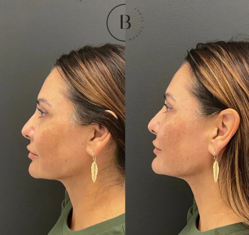 Full Facial Balancing before and after results at Boujee Nurse