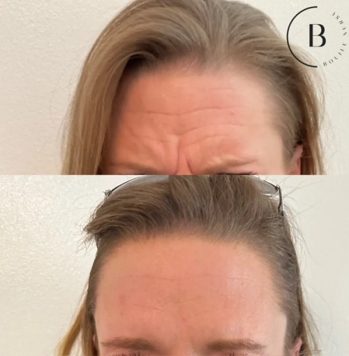 Wrinkle Relaxation before and after results at Boujee Nurse