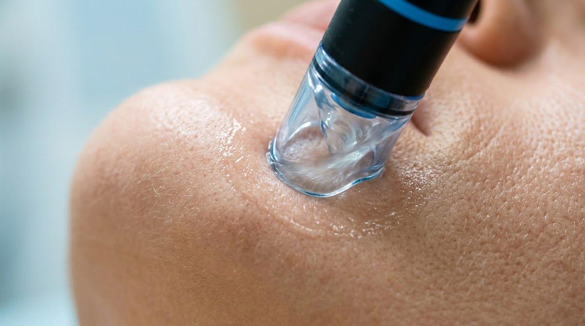 Close-up of HydraFacial wand performing skin extraction.