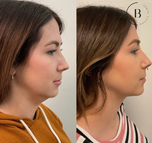 Jawline Refinement before and after results at Boujee Nurse