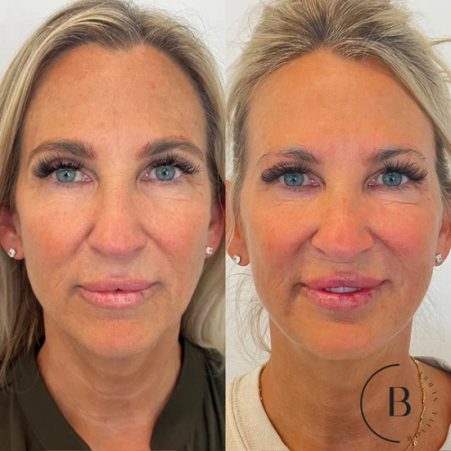 Full Facial Balancing before and after results at Boujee Nurse