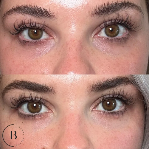 Under-Eye Rejuvenation before and after results at Boujee Nurse
