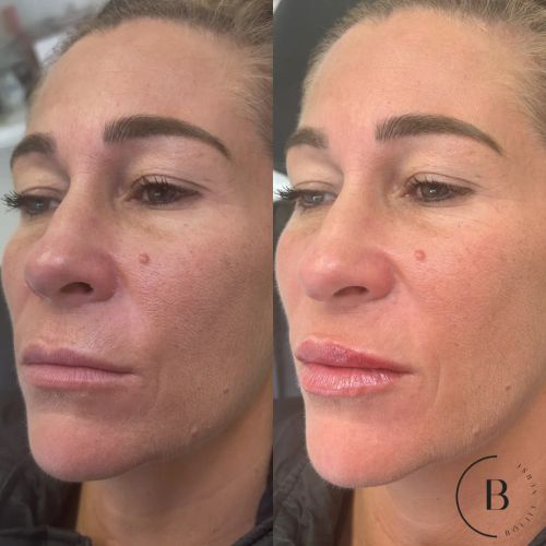 Lip Enhancement before and after results at Boujee Nurse