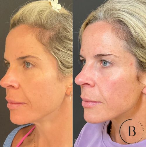 Volume Restoration before and after results at Boujee Nurse