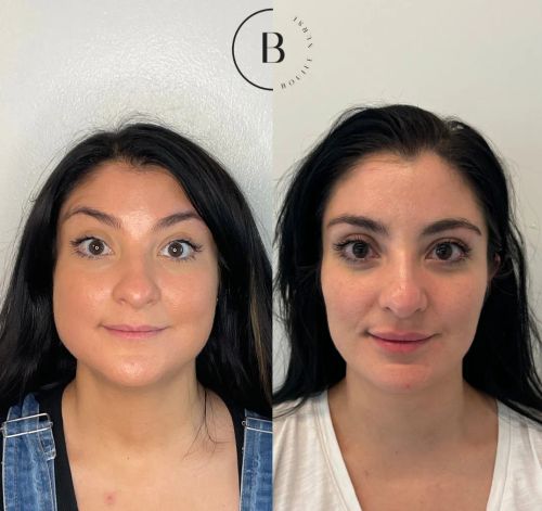 Full Facial Balancing before and after results at Boujee Nurse