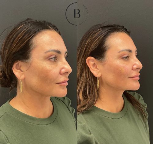 Full Facial Balancing before and after results at Boujee Nurse