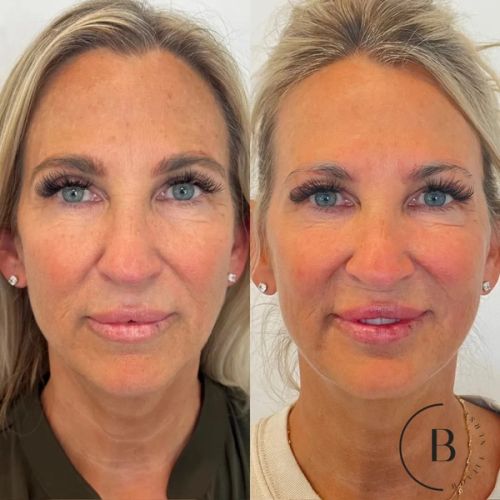 Full Facial Balancing before and after results at Boujee Nurse