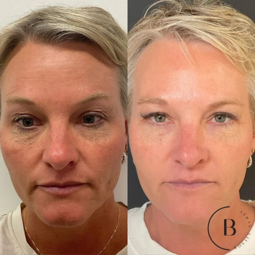 Collagen Restoration before and after results at Boujee Nurse