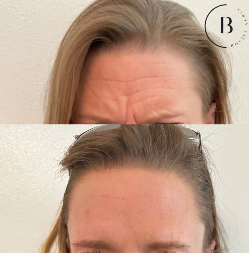 Letybo before and after results at Boujee Nurse