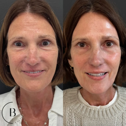 Collagen Restoration before and after results at Boujee Nurse
