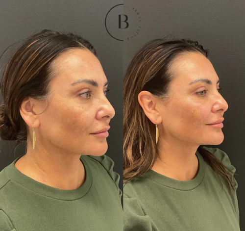 Full Facial Balancing before and after results at Boujee Nurse