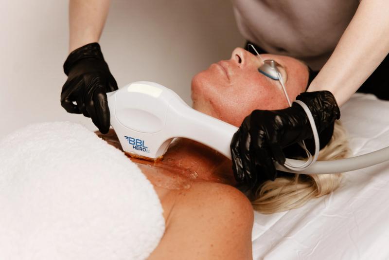 Laser Treatments