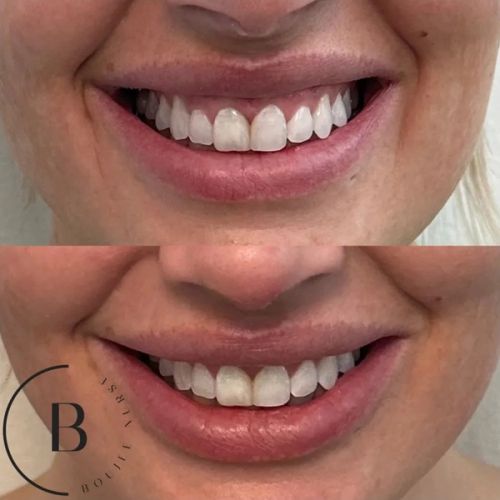 Gummy Smile Correction before and after results at Boujee Nurse