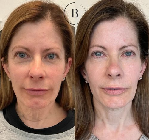Collagen Restoration before and after results at Boujee Nurse
