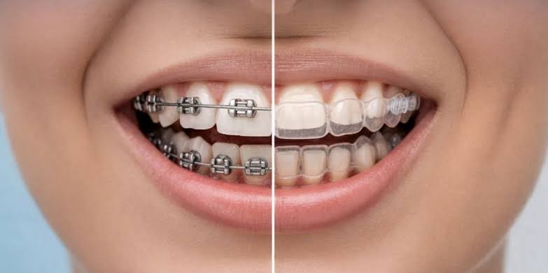 Behel atau Clear Aligner, Mana yang Lebih Cocok?