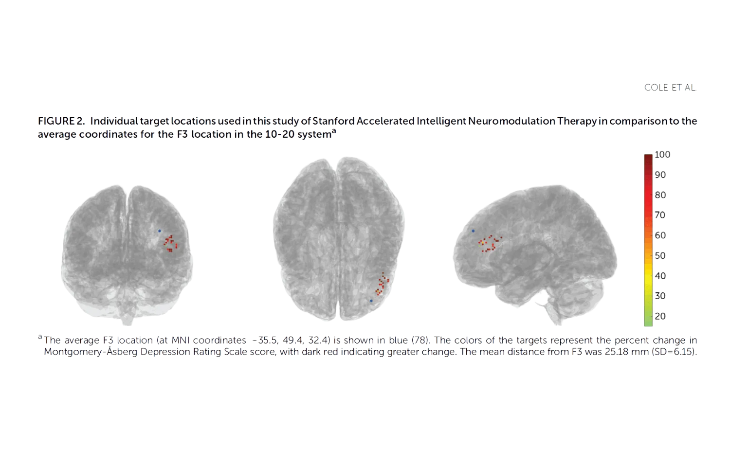 Cole et al study graphic showing brain scans from different angles of the targets representing the percent change in Montgomery-Äsberg Depression Rating Scale score, with dark red indicating greater change. Most of the dots are in one area and dark red.