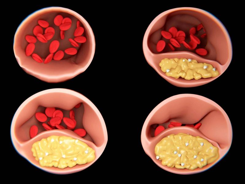 Impact du cholestérol sur l'hypertension
