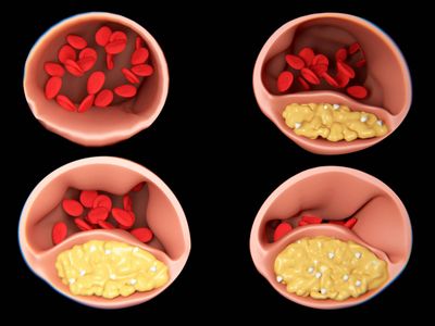 Impact du cholestérol sur l'hypertension