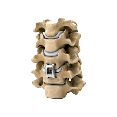 Pressio Spine Continuum fixation system