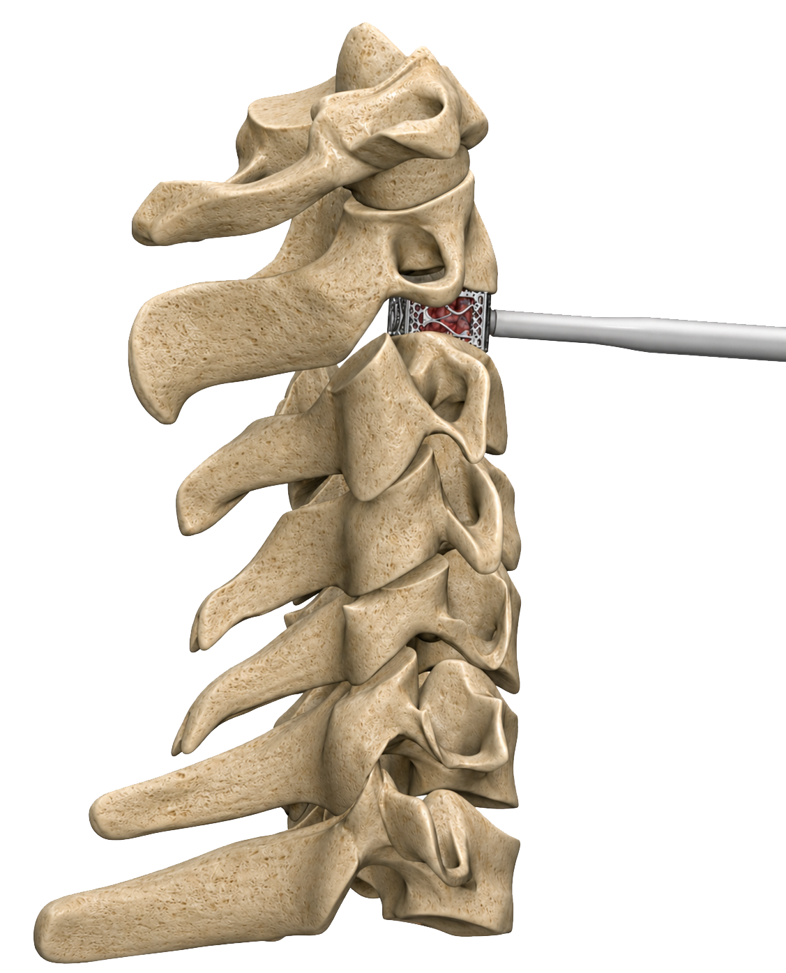 PressioSpine_TIDAL_Cervical