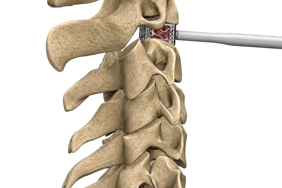 PressioSpine_TIDAL_Cervical