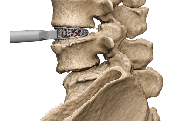 TIDAL® Anterior Lumbar Interbody Fusion System