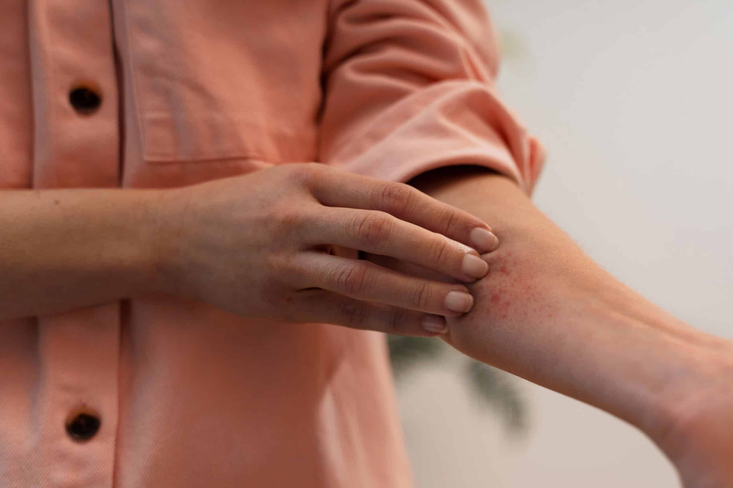 heroin-and-its-effect-on-your-skin-3
