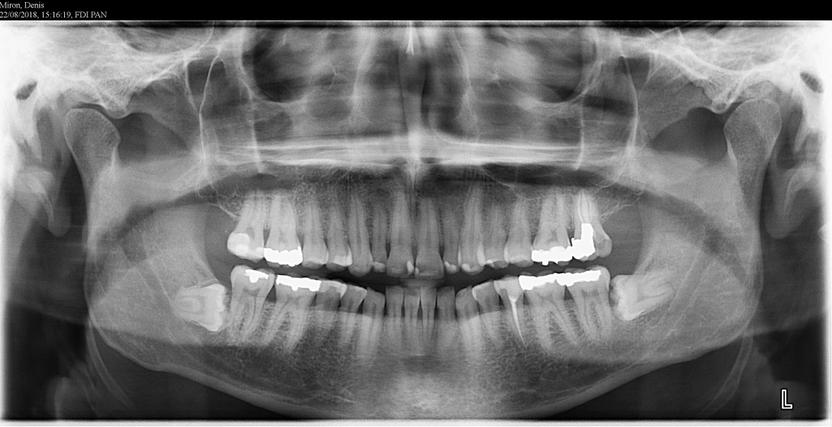 Radiographie d'une mâchoire de face, avec la présence des deux dents de sagesse du bas positionnées à l'horizontale.