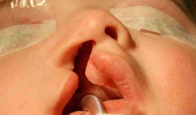 Photo montrant la lèvre supérieure atteinte d'une fente labio-maxillo-palatine droite.