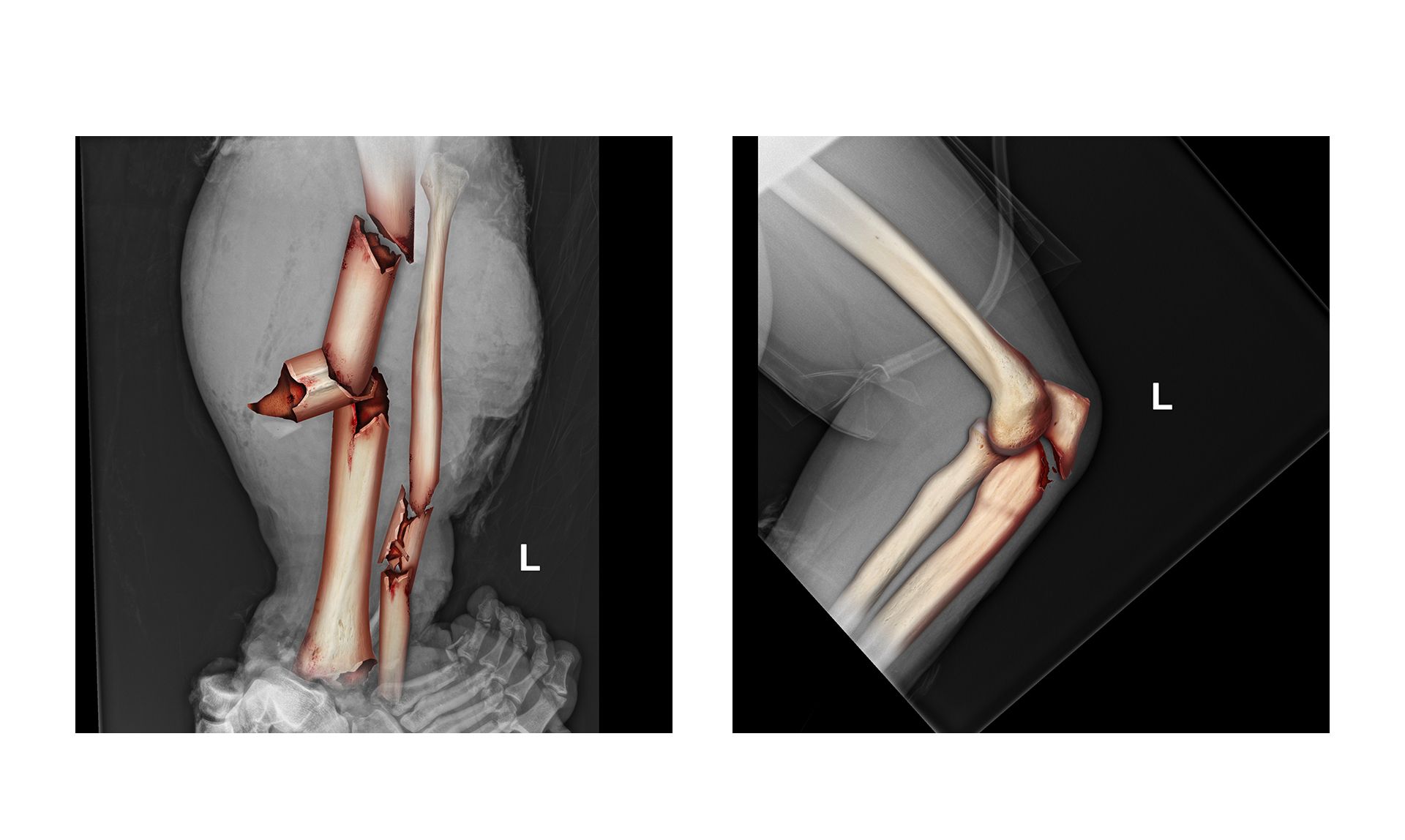 X-Ray Fracture Illustrations Image