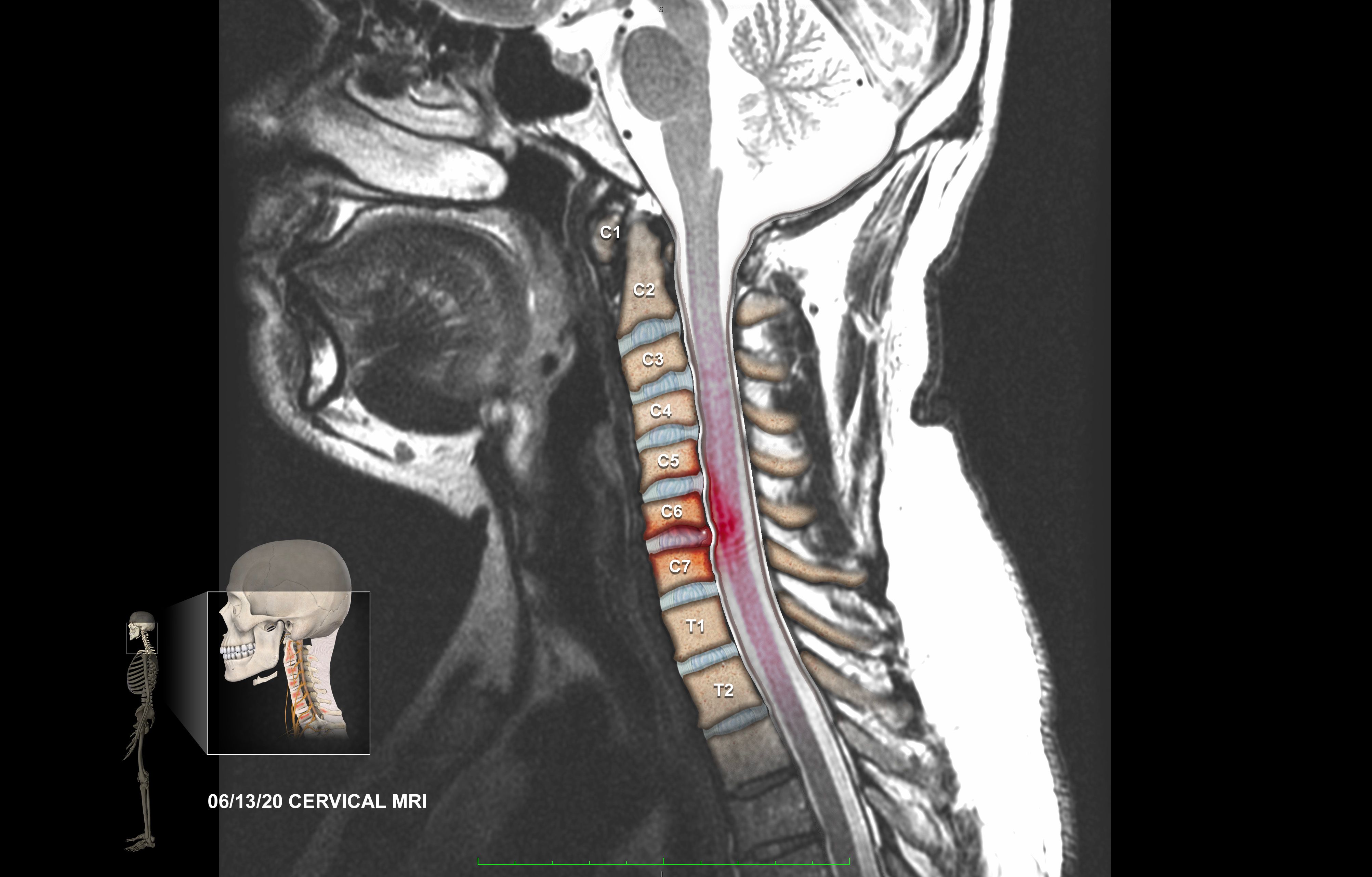 Cervical MRI Illustration Image