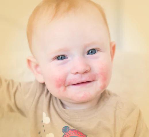 Photo of smiling baby with atopic dermatitis rash around mouth