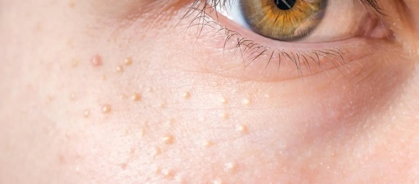 Facial Milia Cysts: A Quick Guide to Understanding, Preventing, and Eliminating Them