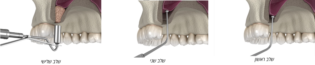 המחשה לשלבי הביצוע בהרמת סינוס