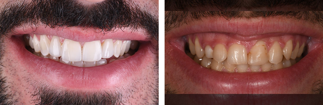 לפני ולאחר טיפול בגאמי סמייל - GINGIVECTOMY הארכת כותרות שיניים באמצעות לייזר + ציפויי חרסינה/ למינייט