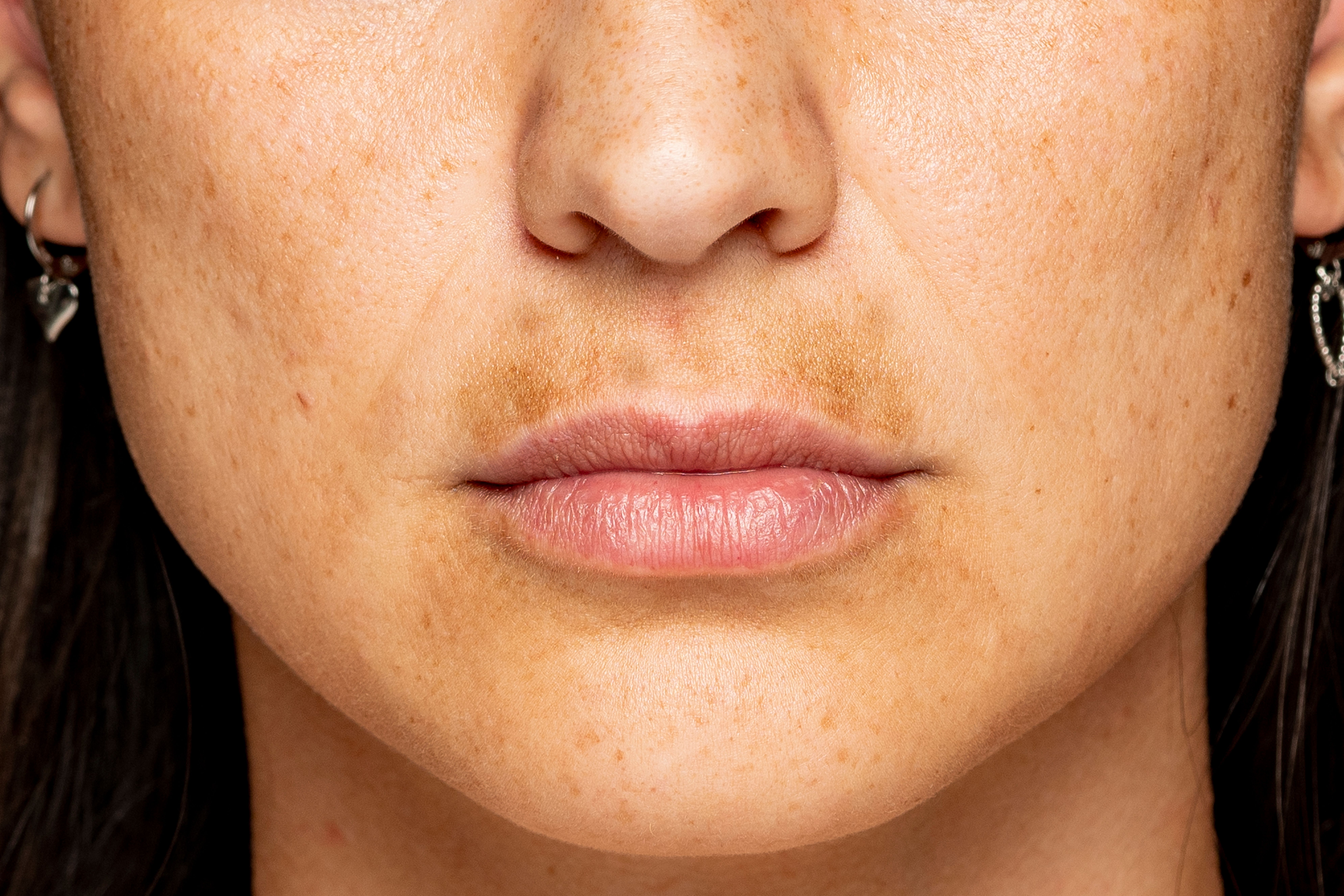 Hyperpigmentation Around the Mouth Causes, Treatment, and Prevention