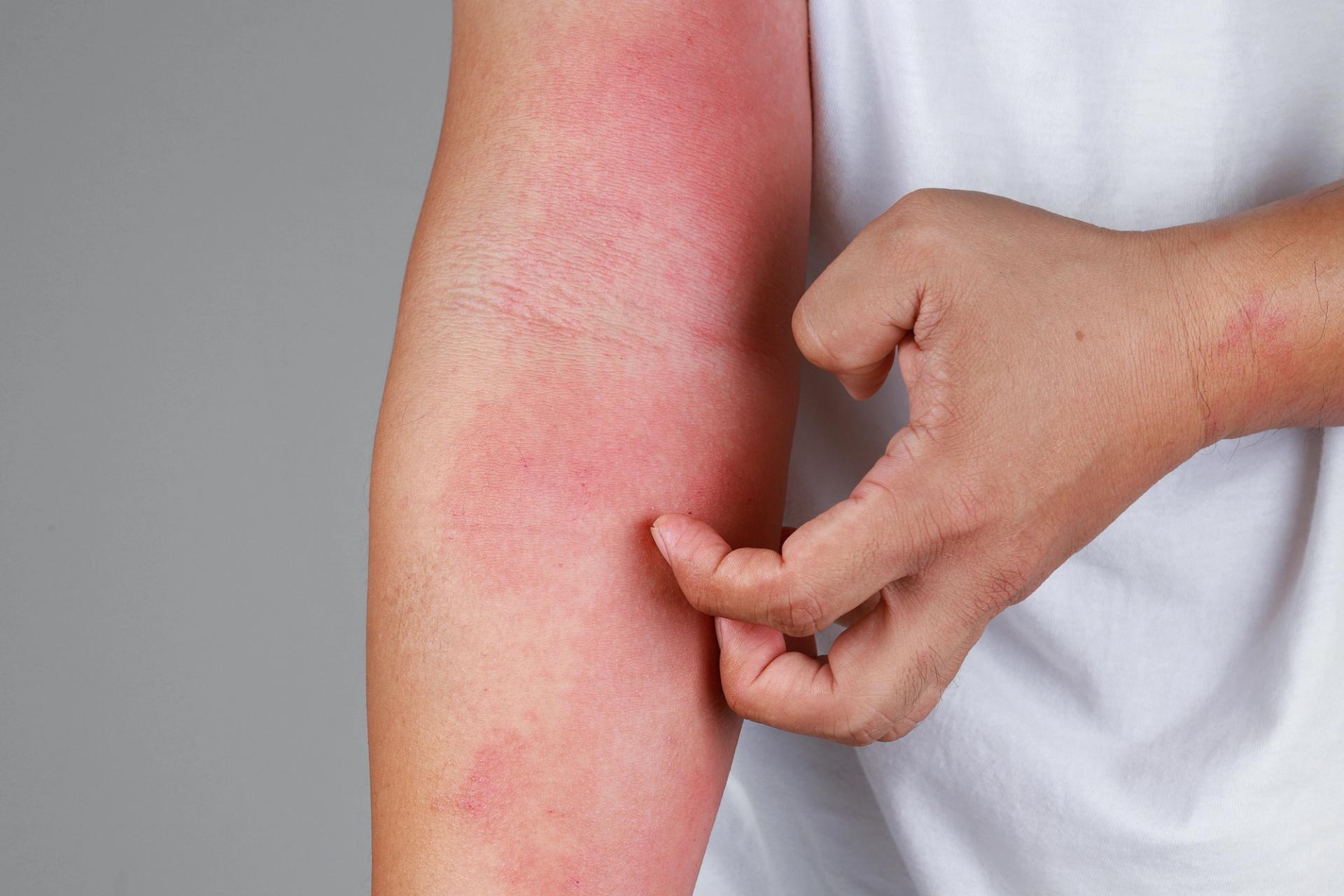 Atopic Dermatitis Eczema: Symptoms, Treatments, and Clinical Trialsimage