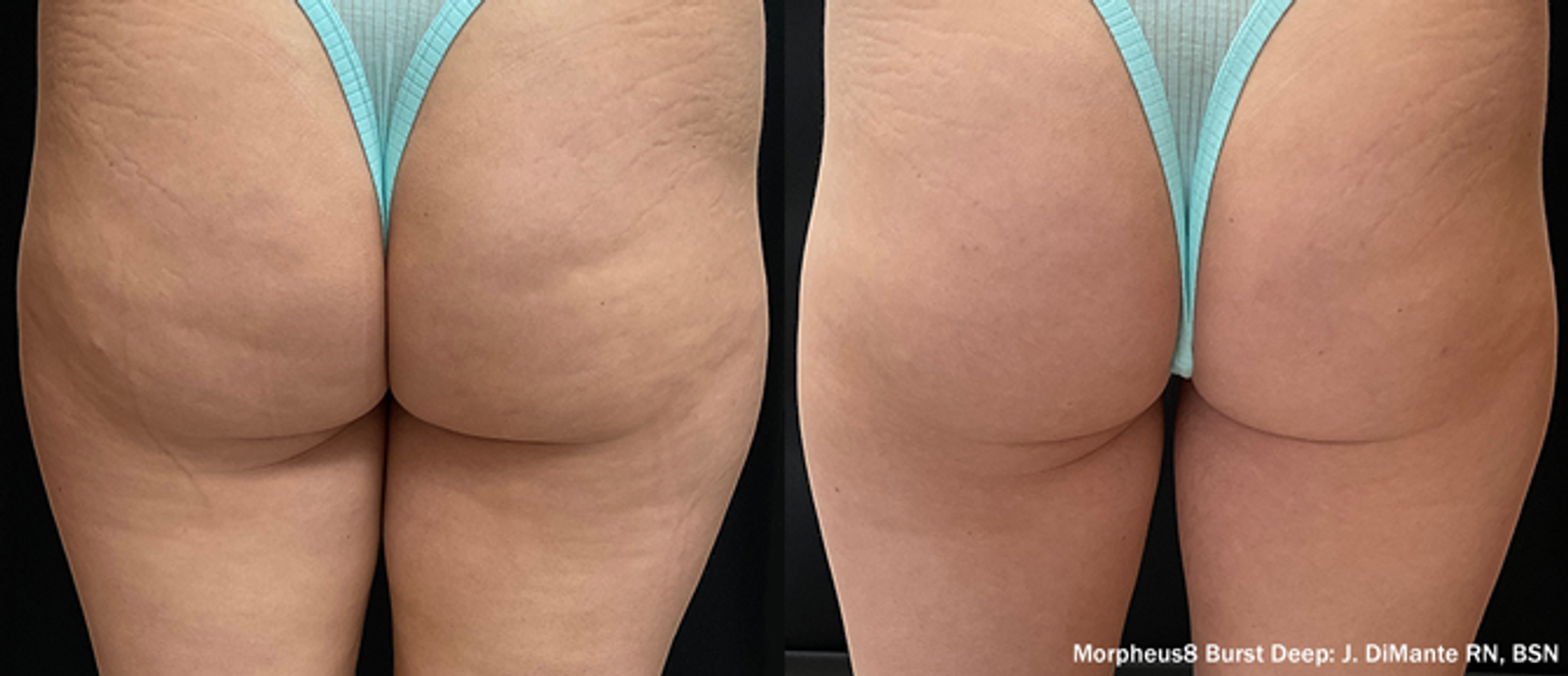 Manufacturer-provided Morpheus8 before and after example for the buttocks