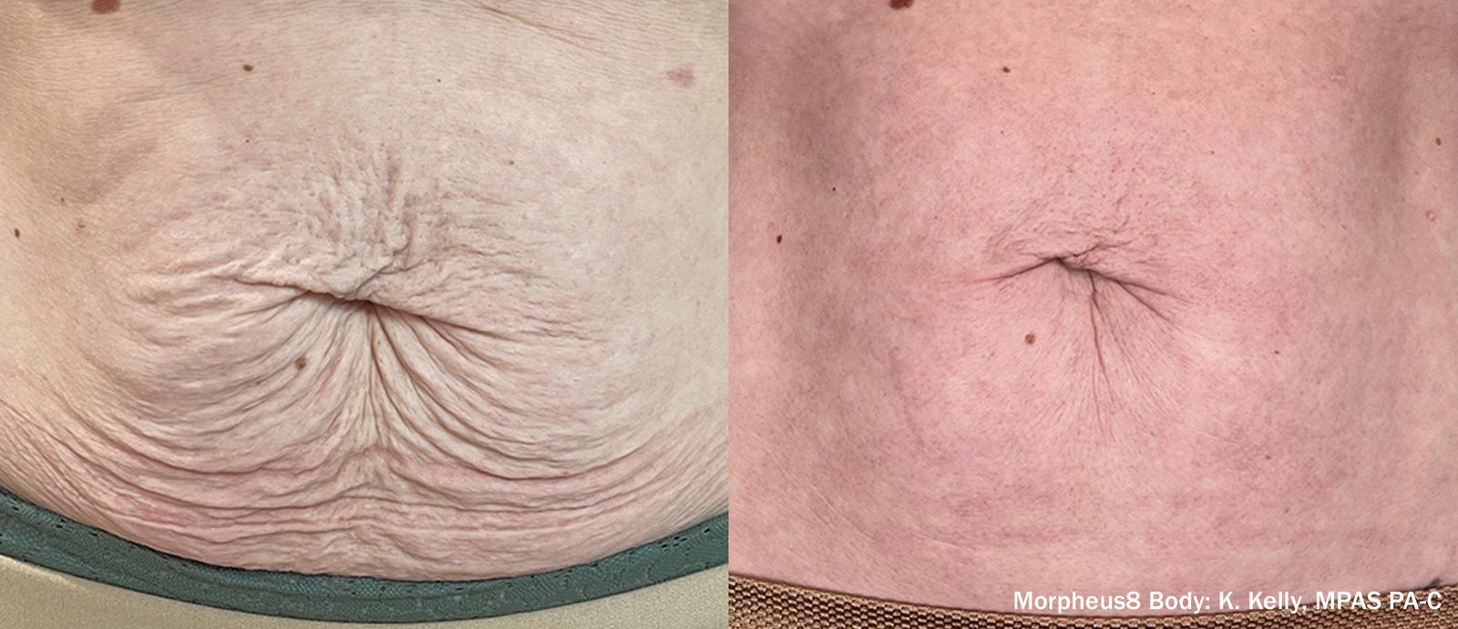 Manufacturer-provided abdominal Morpheus8 before and after example