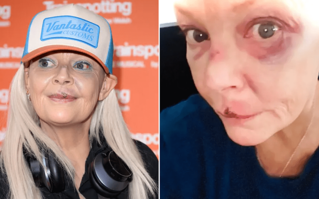 Gail Porter suffers agonising facial injuries after being knocked down Tube stairs