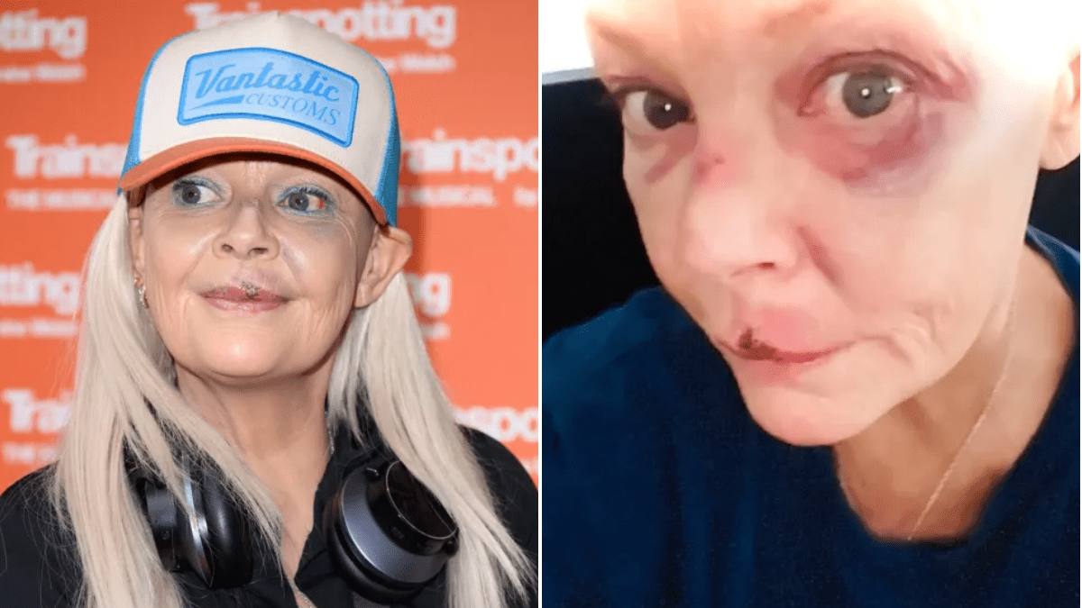 Gail Porter suffers agonising facial injuries after being knocked down Tube stairs — News news on dripviewz