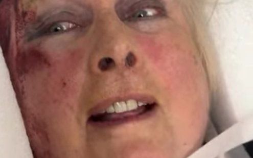 Binky Felstead's mum shares alarming video strapped to hospital bed with blood down her face